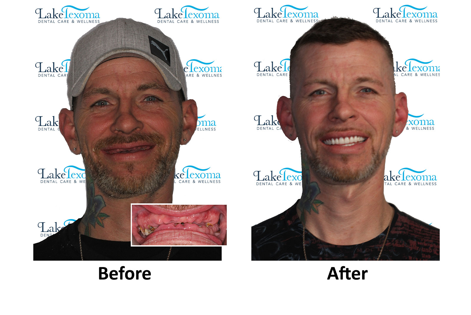 Headshot of patients before and after procedure