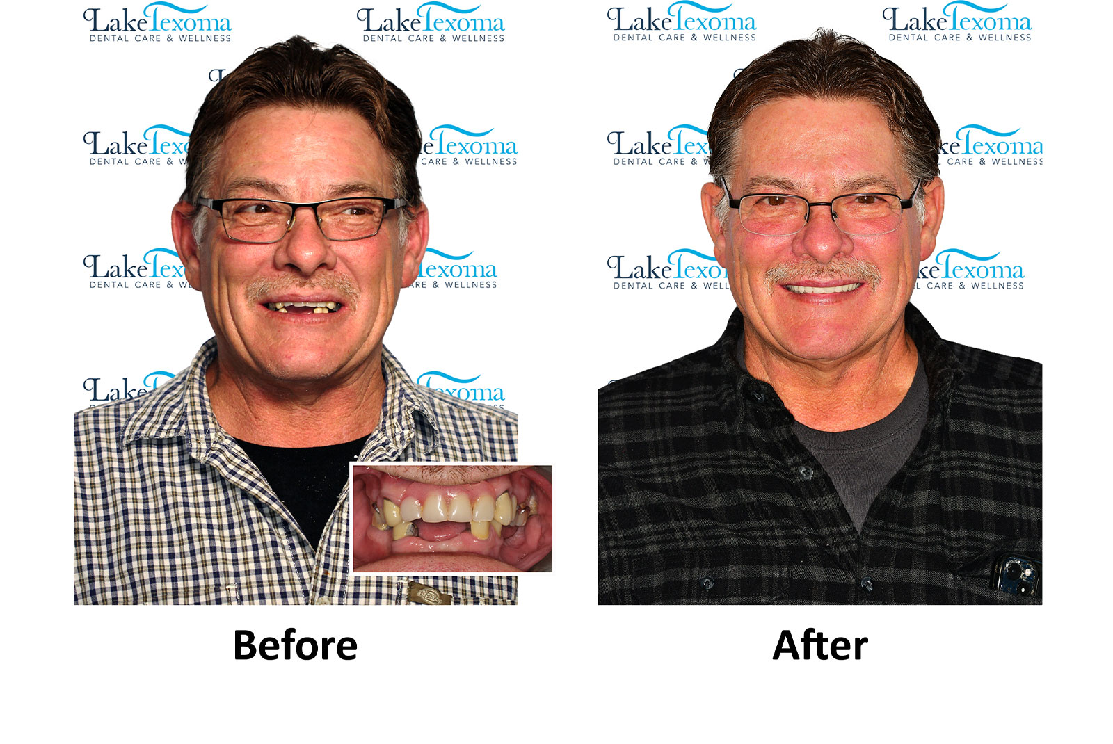 Headshot of patients before and after procedure
