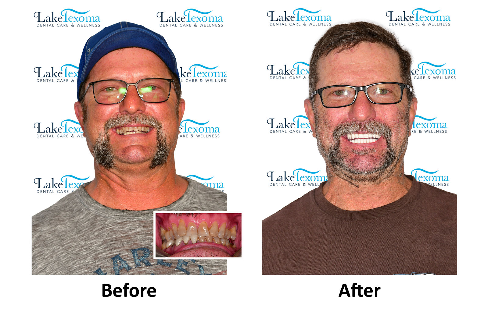 Headshot of patients before and after procedure