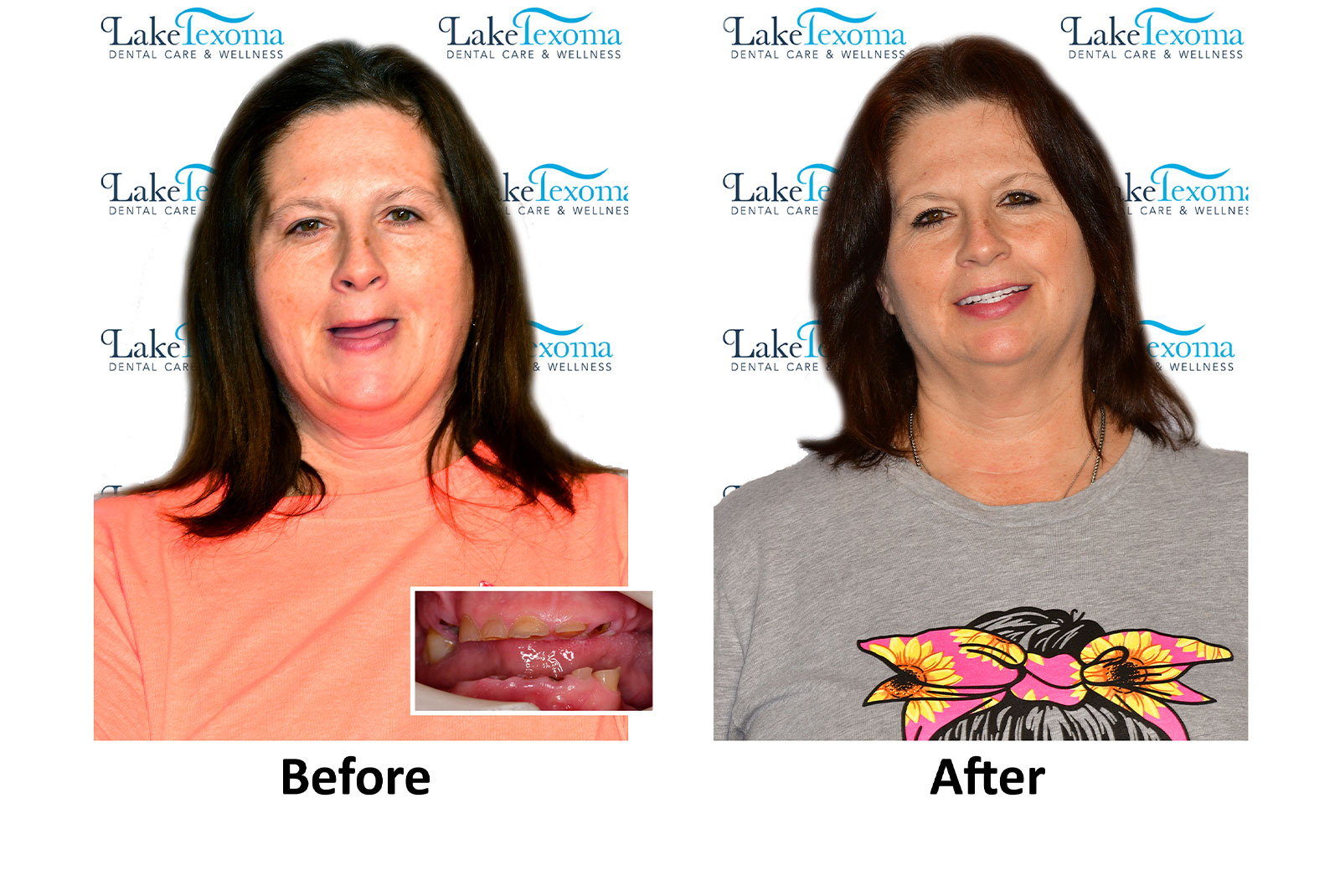 Headshot of patients before and after procedure