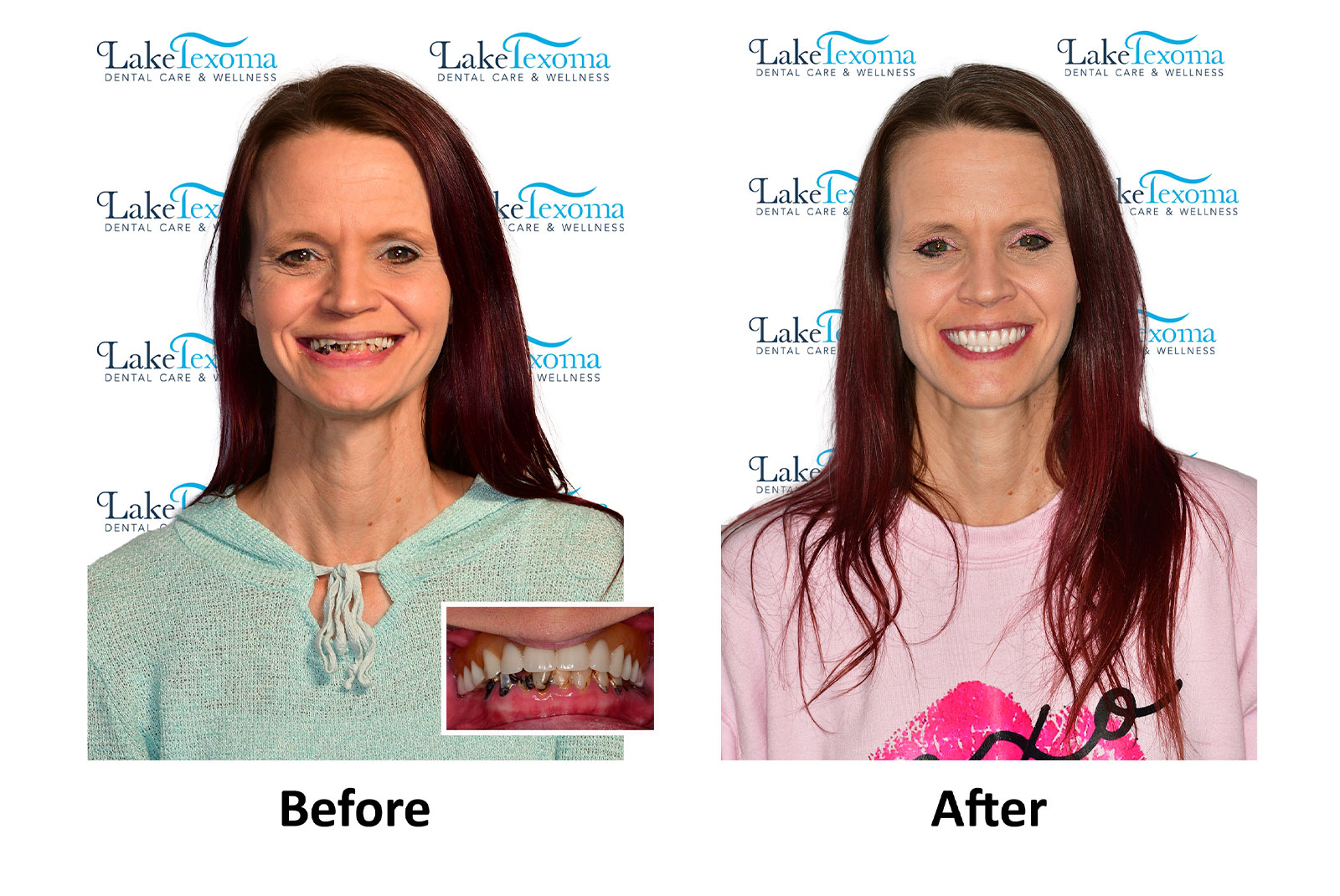 Headshot of patients before and after procedure