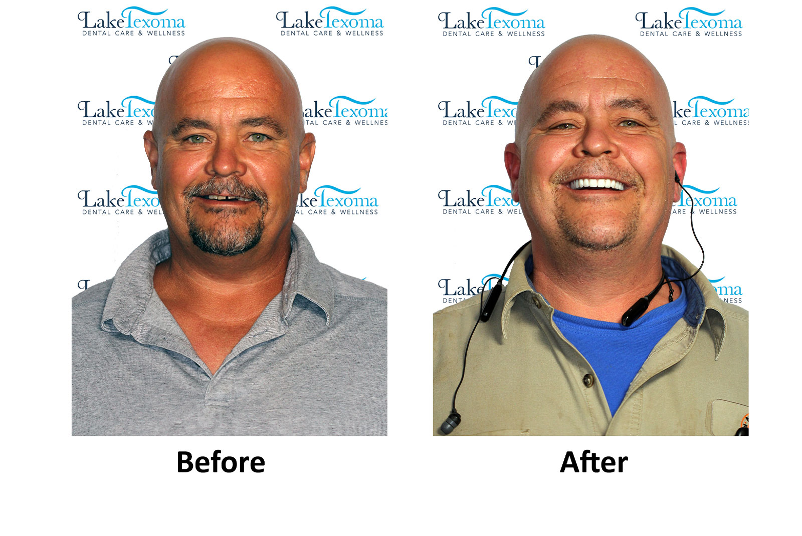 Headshot of patients before and after procedure