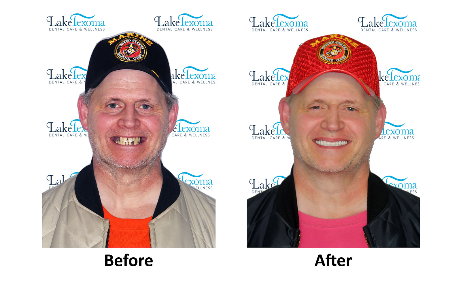 Headshot of patients before and after procedure