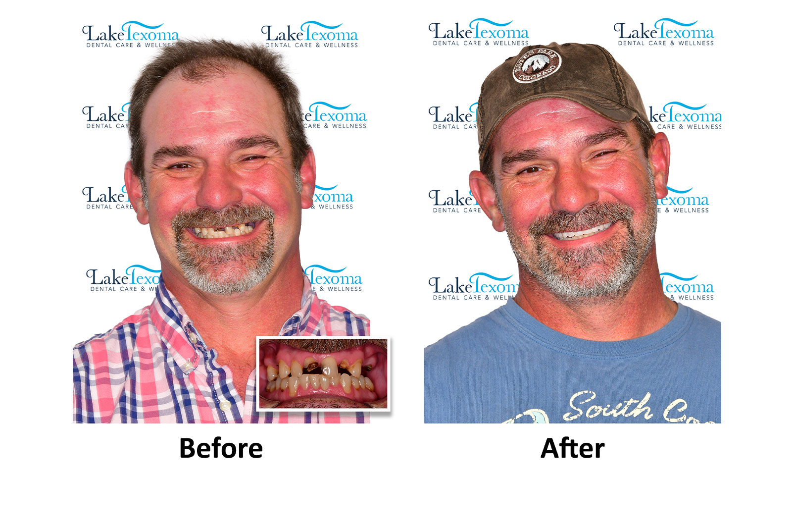 Headshot of patients before and after procedure