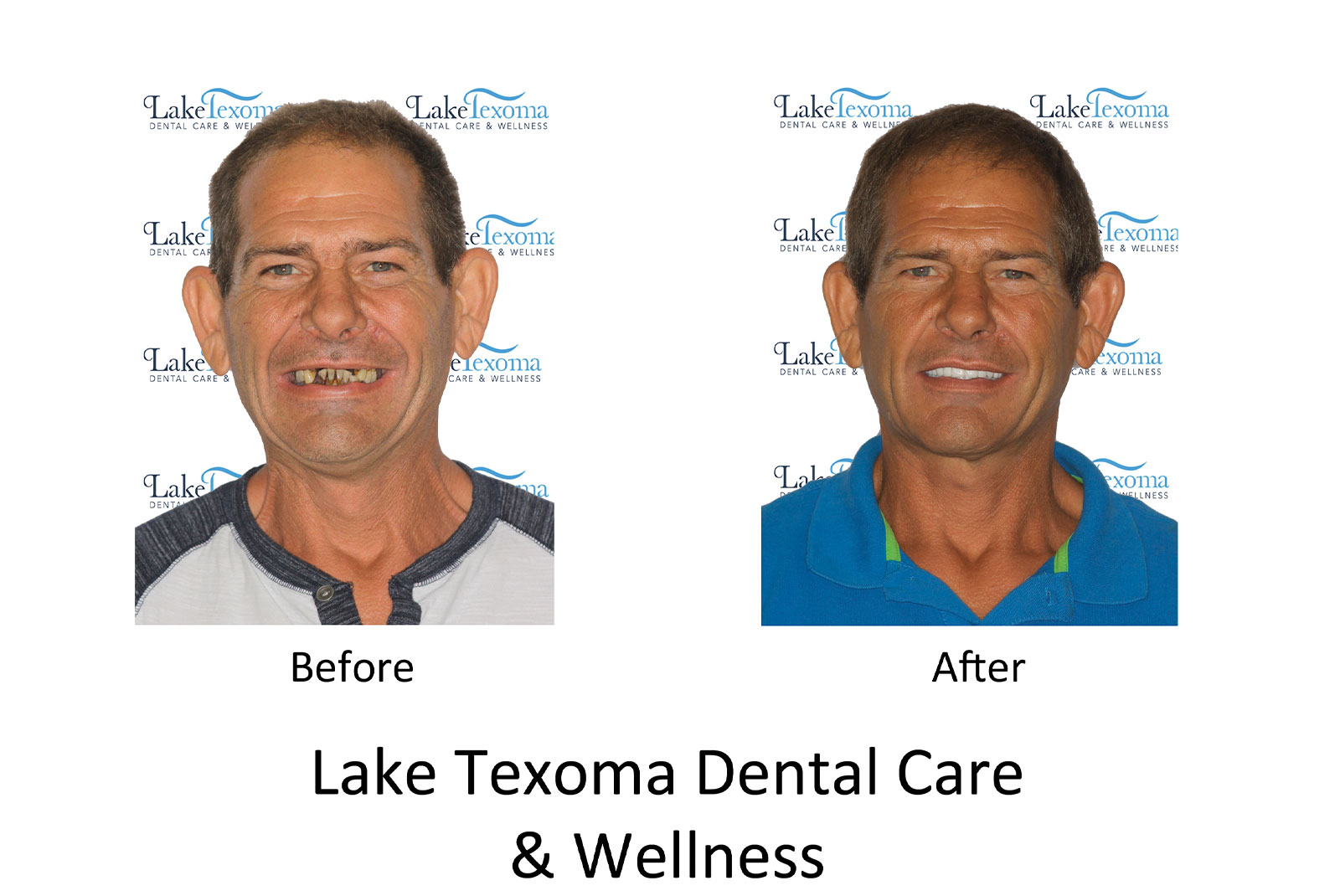 Headshot of patients before and after procedure