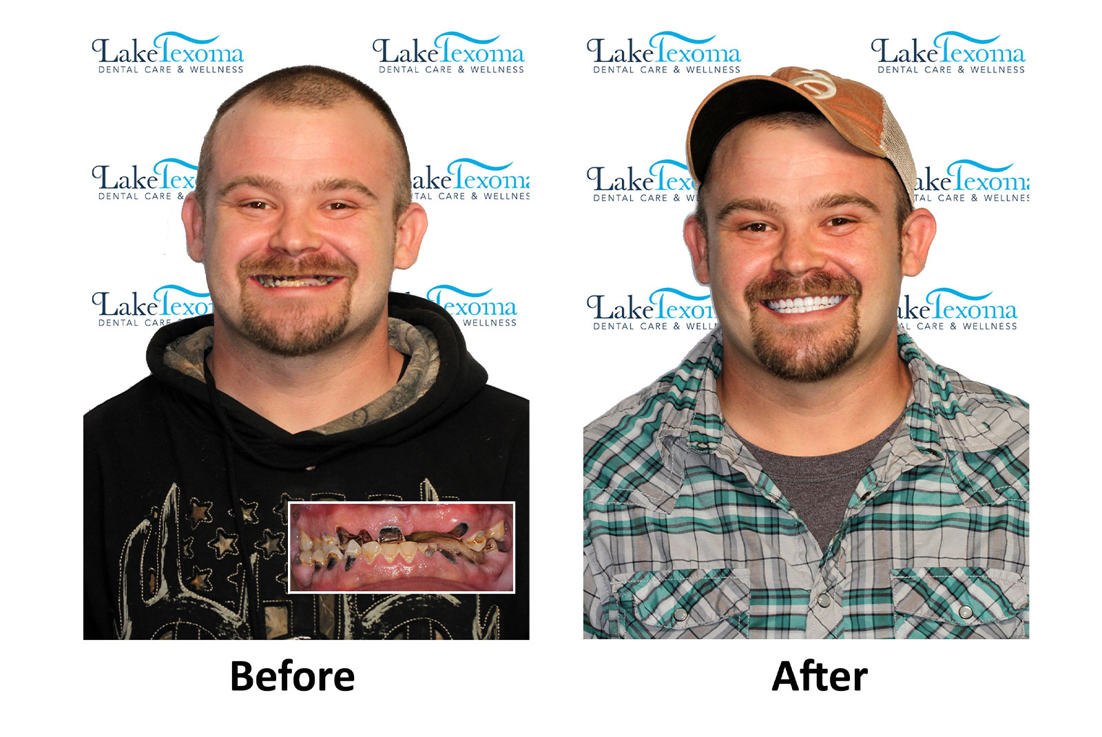 Headshot of patients before and after procedure