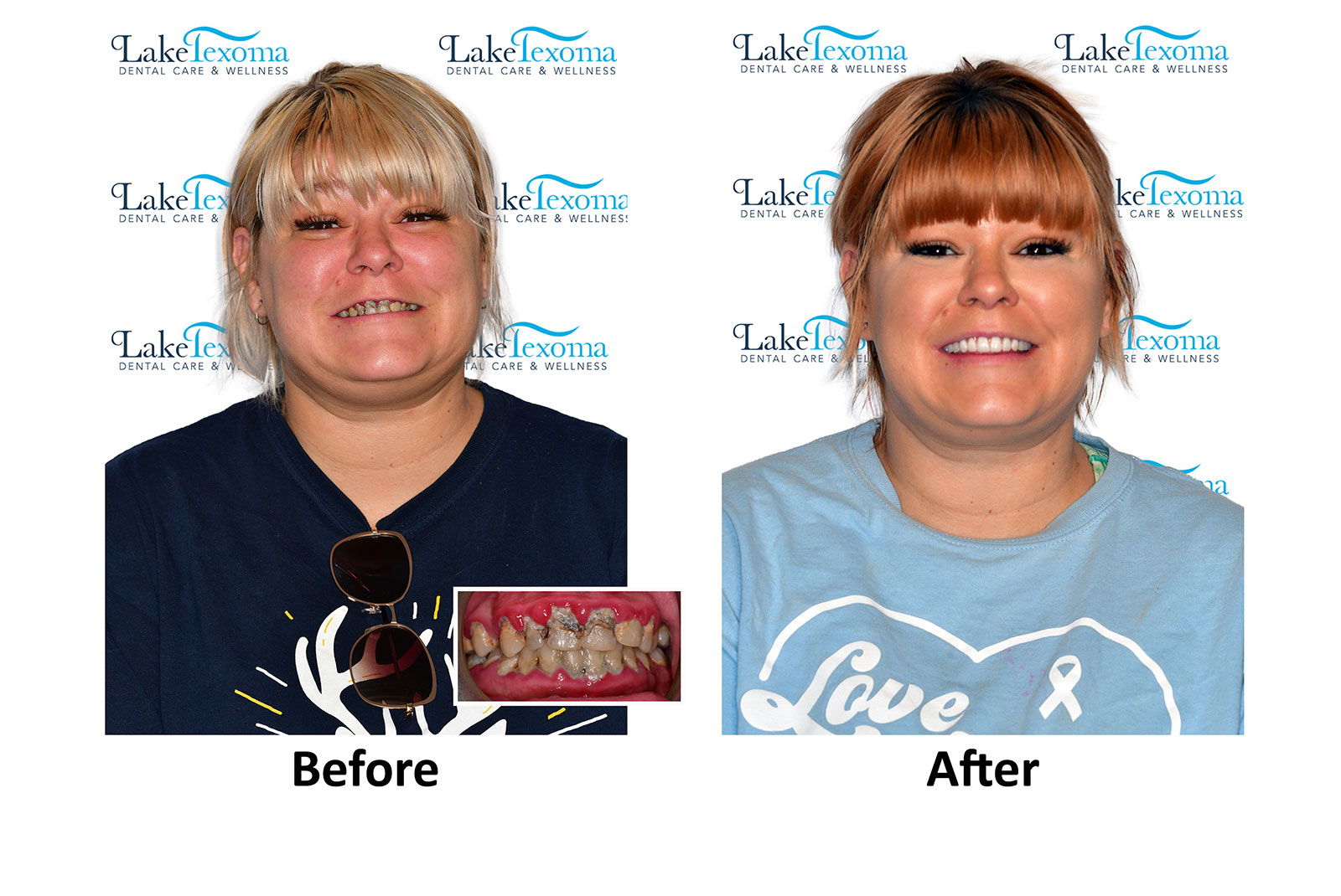 Headshot of patients before and after procedure