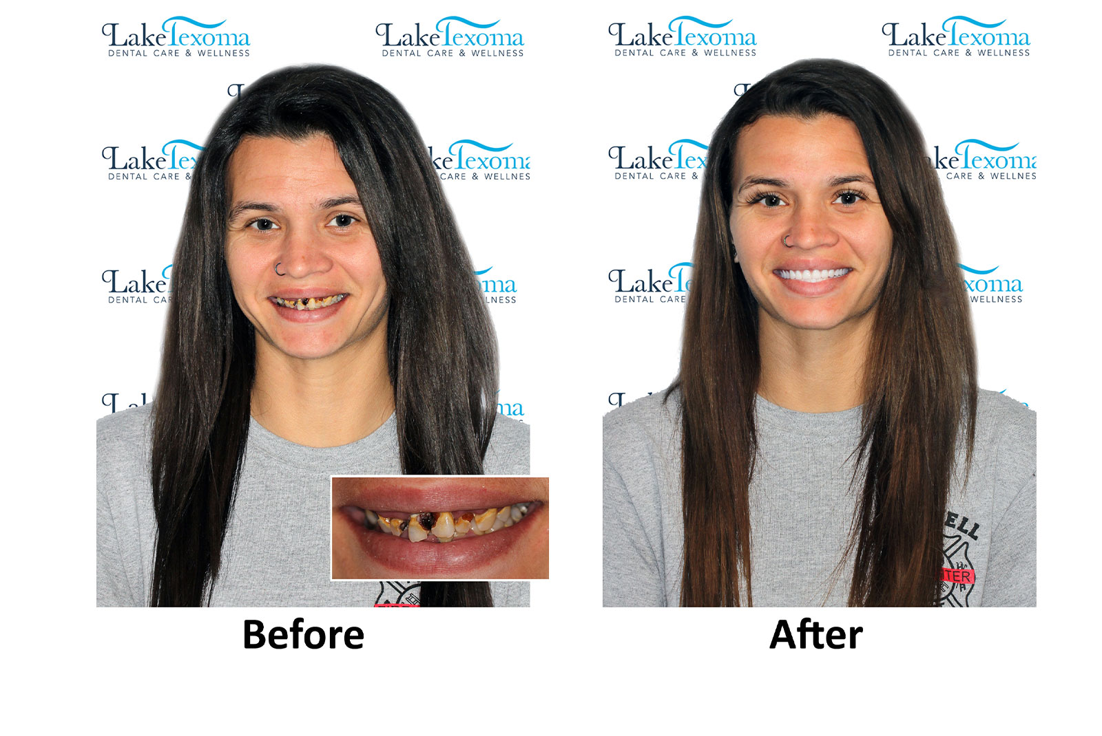 Headshot of patients before and after procedure