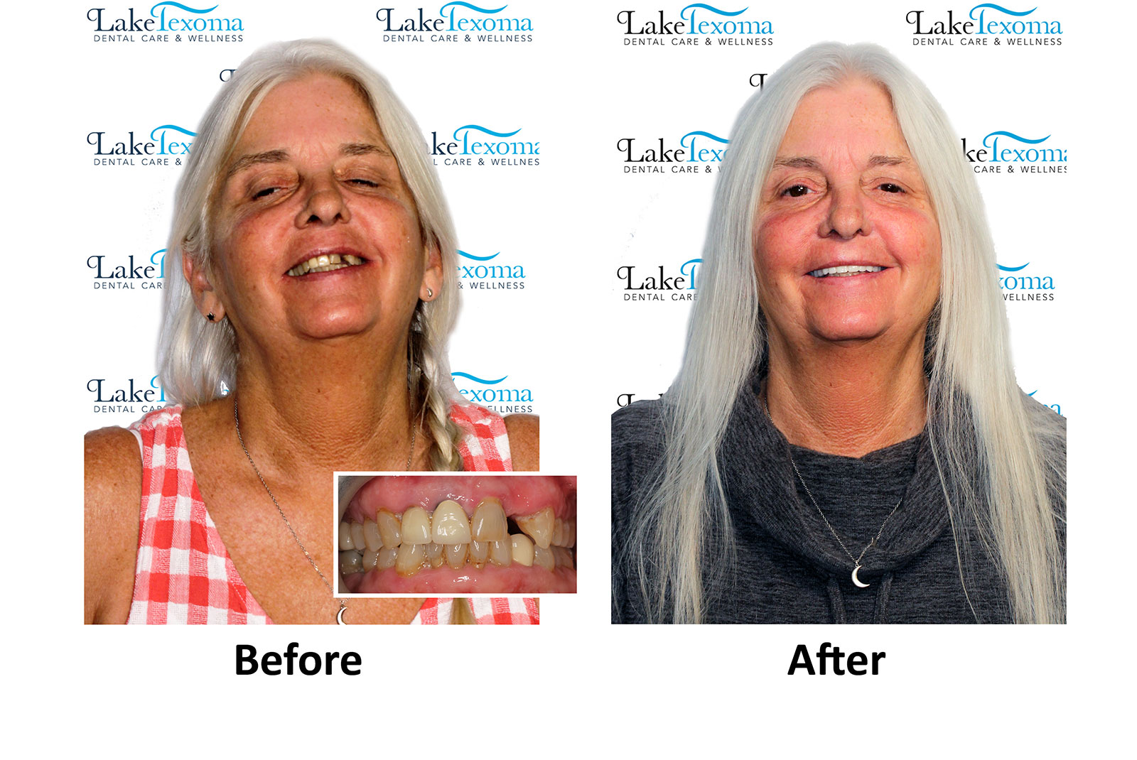 Headshot of patients before and after procedure
