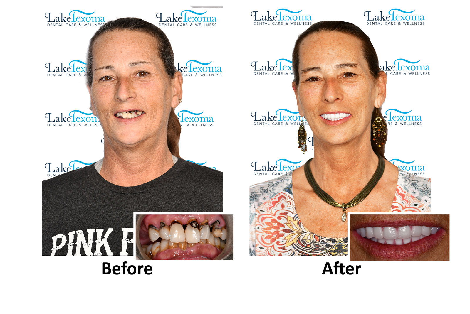 Headshot of patients before and after procedure