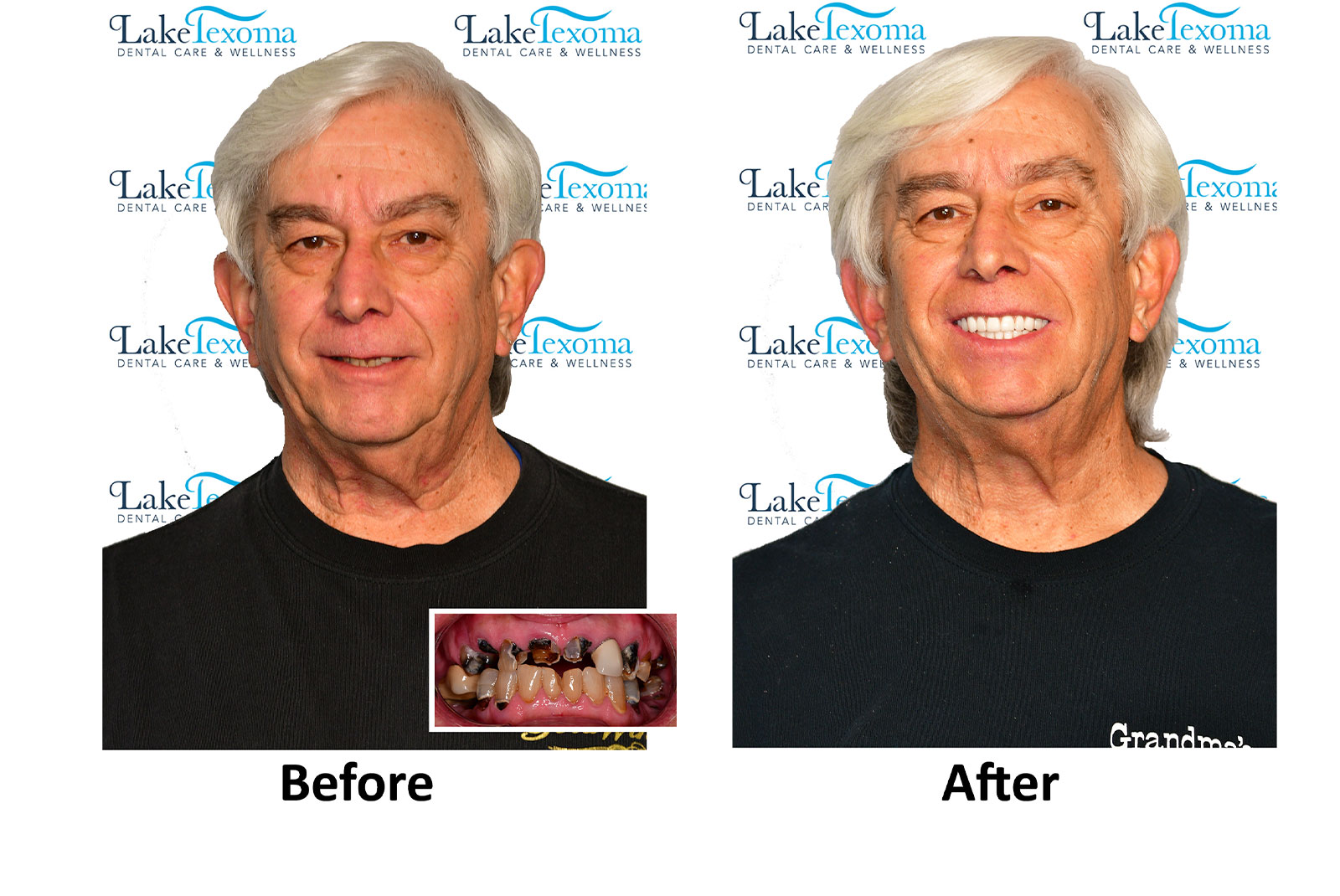 Headshot of patients before and after procedure