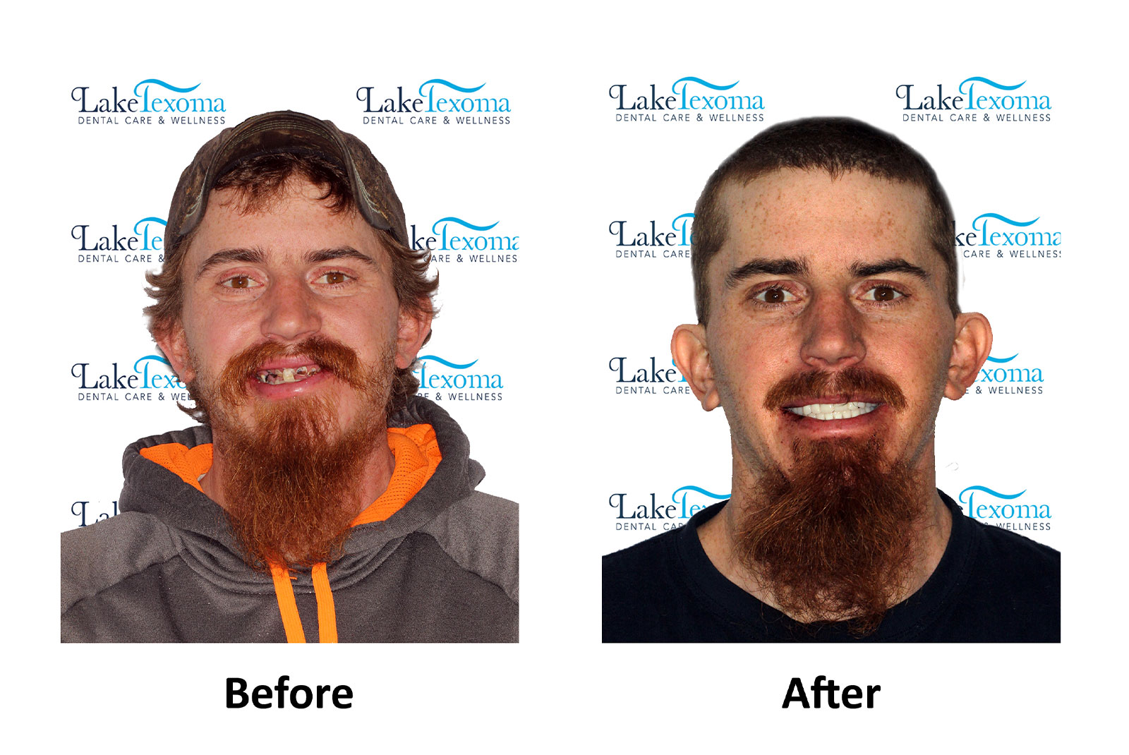 Headshot of patients before and after procedure