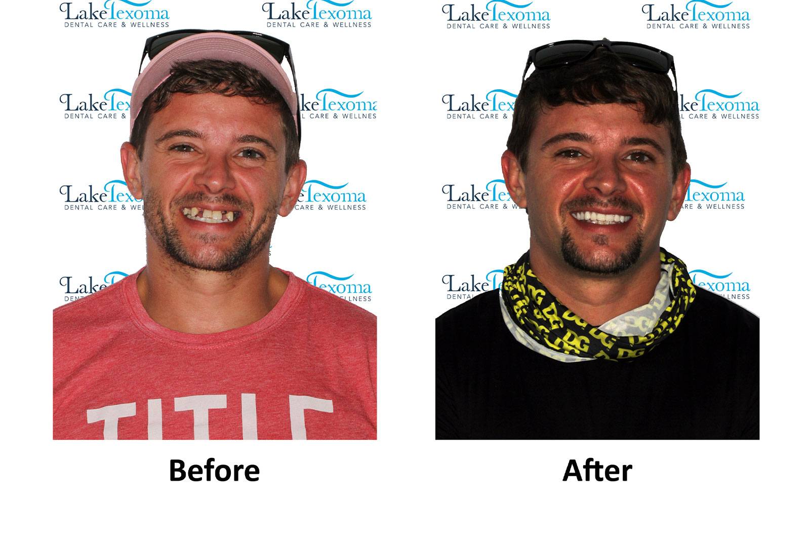 Headshot of patients before and after procedure