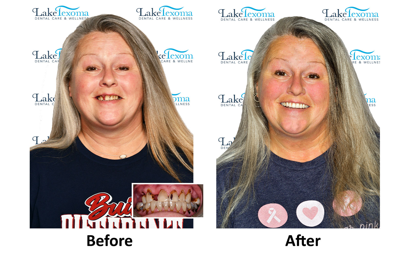 Headshot of patients before and after procedure