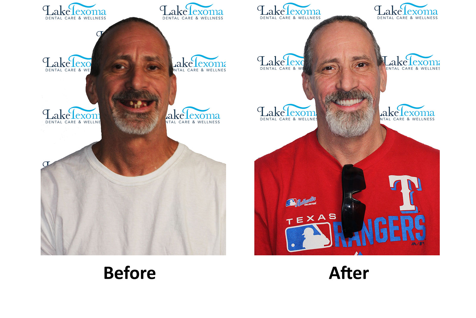 Headshot of patients before and after procedure