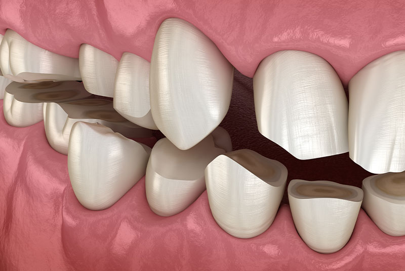 Bruxism