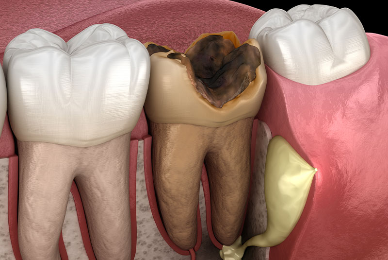 Tooth Abscess