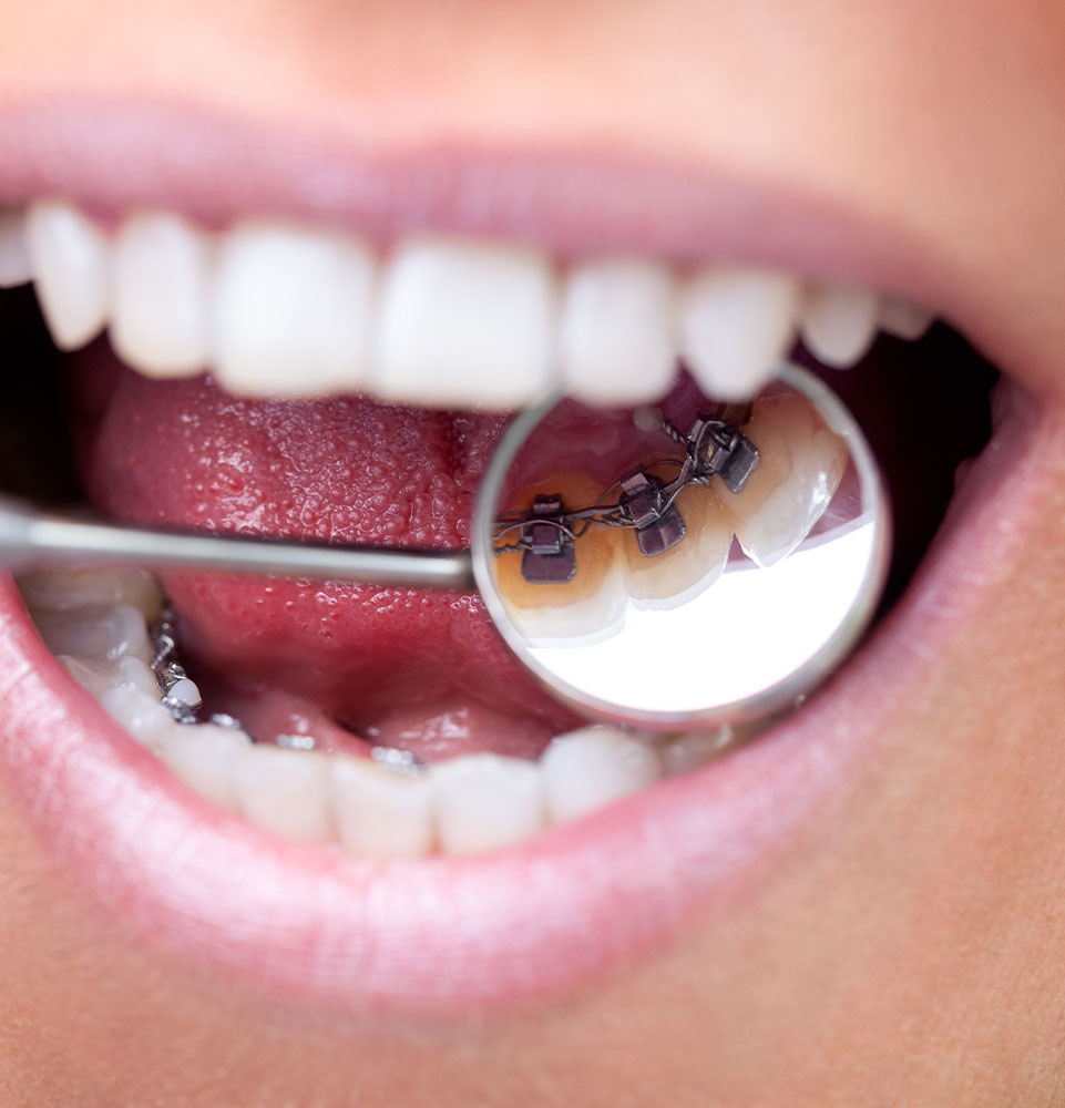 Braces