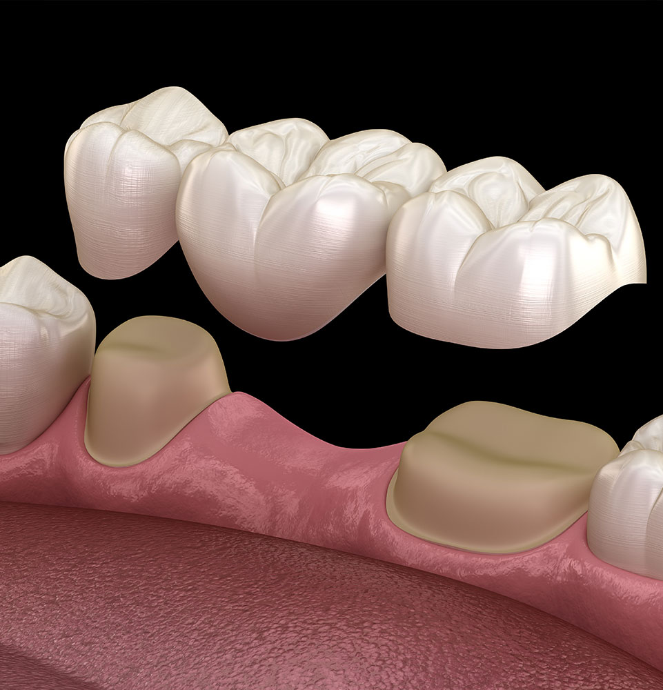 Dental bridge