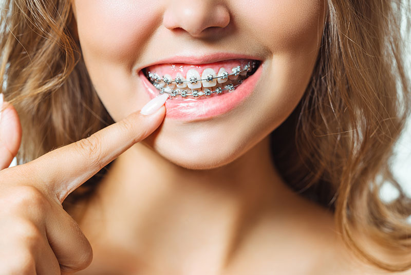 Braces