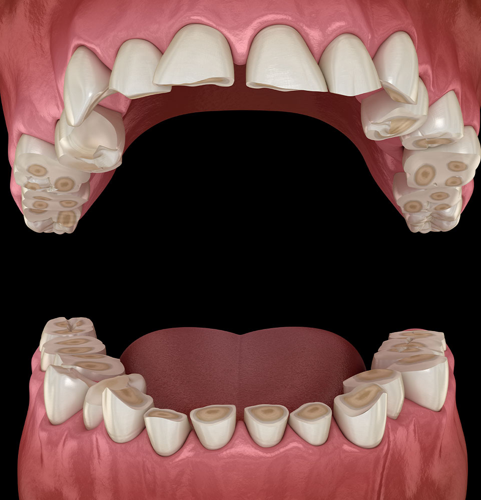 Bruxism