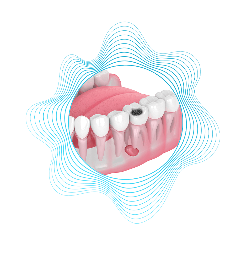 Cavity