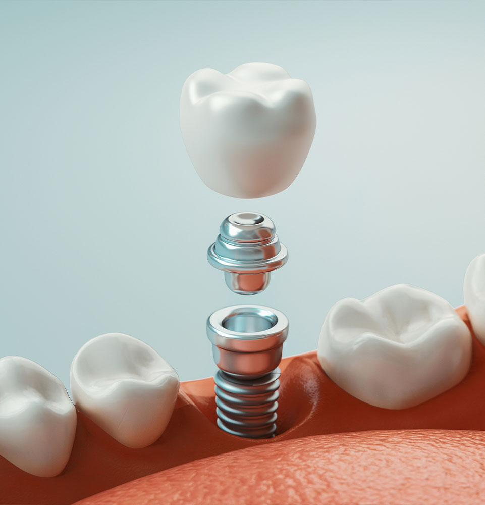 Dental implants