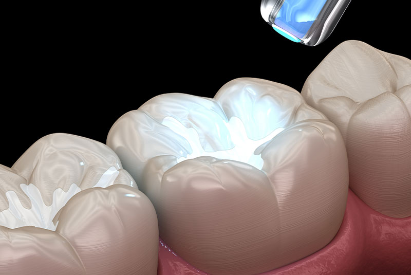 Cavities fillings