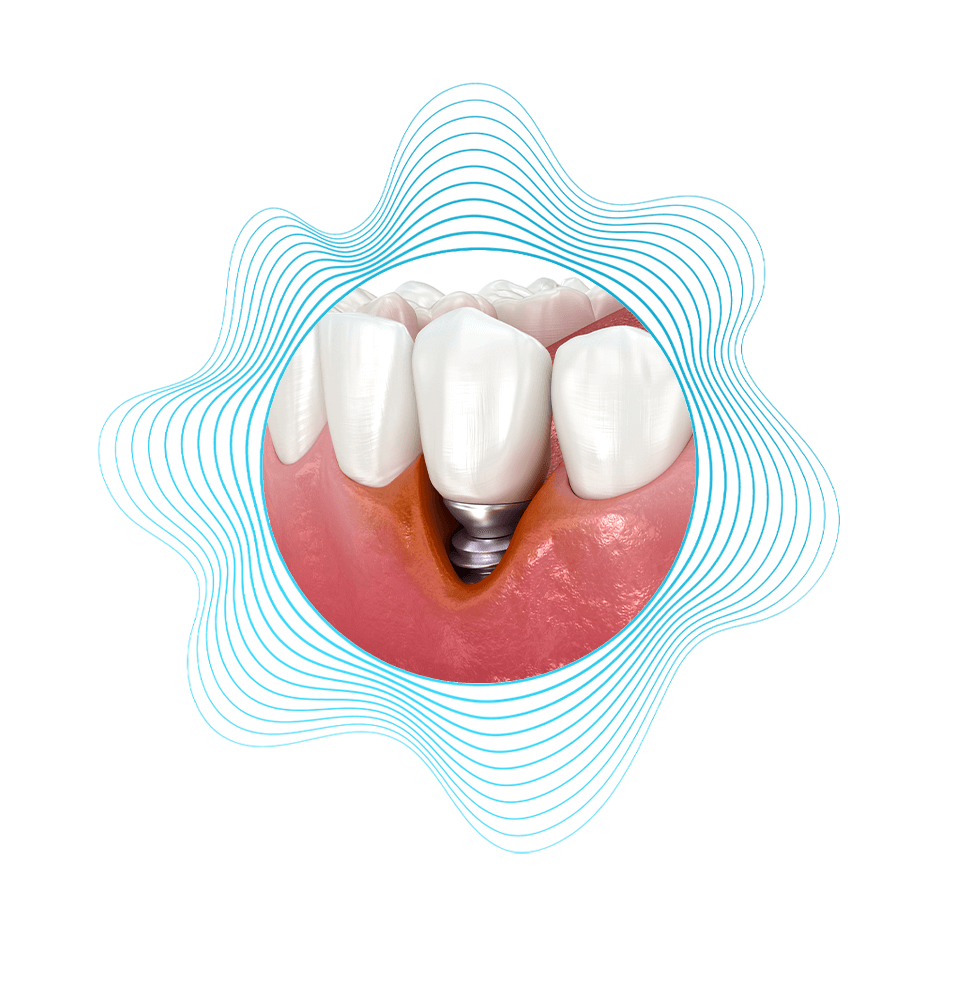 Failing dental implants