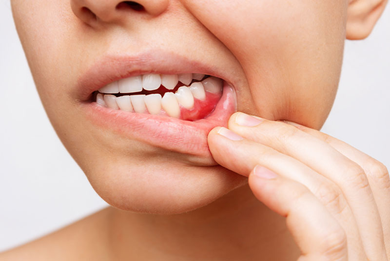 Gum Disease