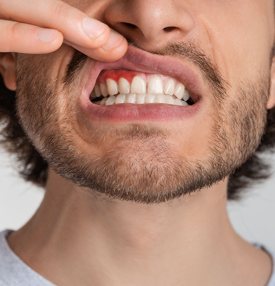 Gum Disease
