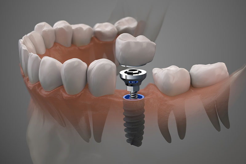 dental implants