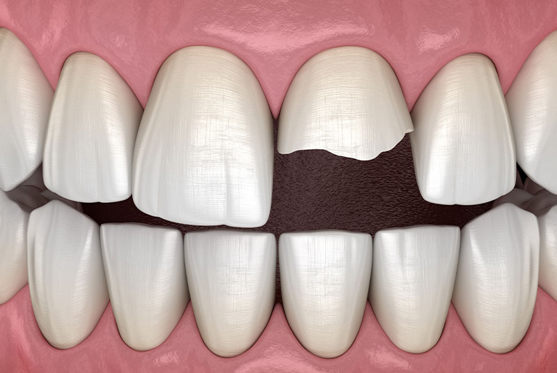 Broken tooth