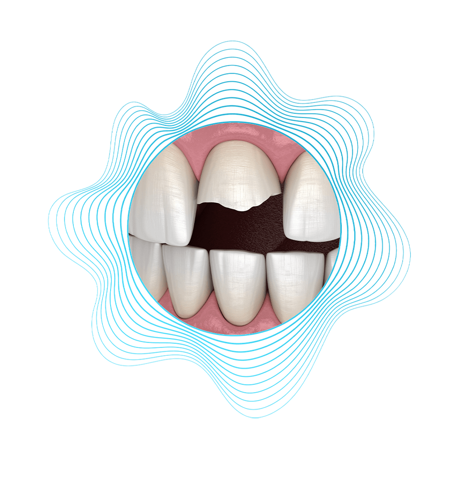 cracked tooth