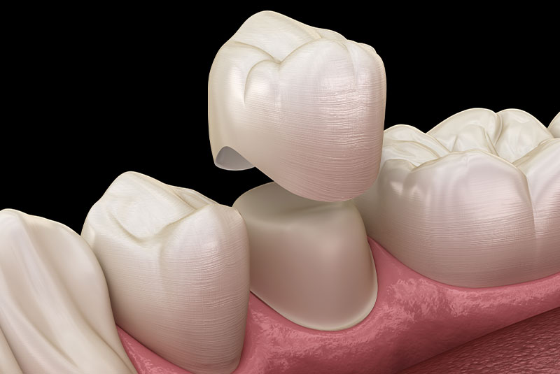 Dental Crowns