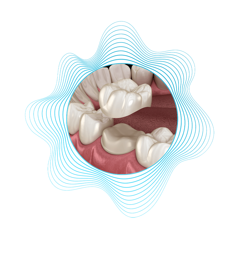 Dental Crown