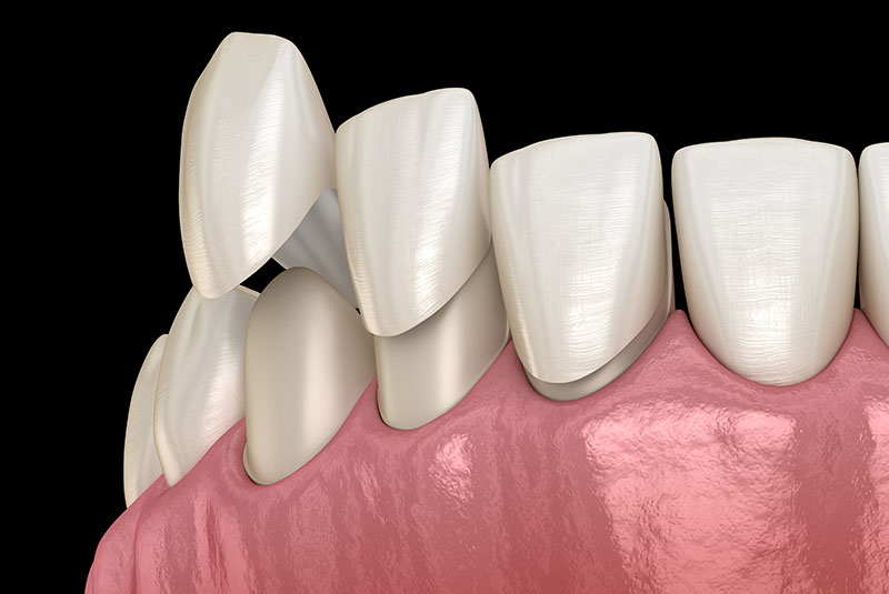 Veneers
