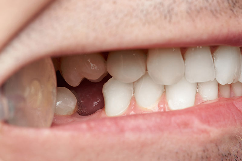 missing tooth