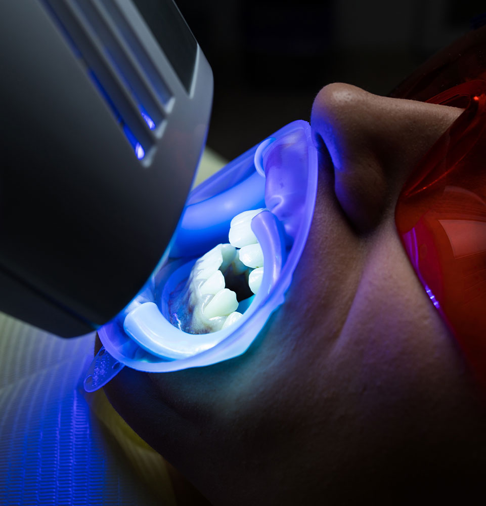 Woman in the middle of teeth whitening procedure