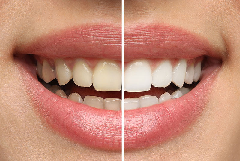 Before and after of teeth whitening